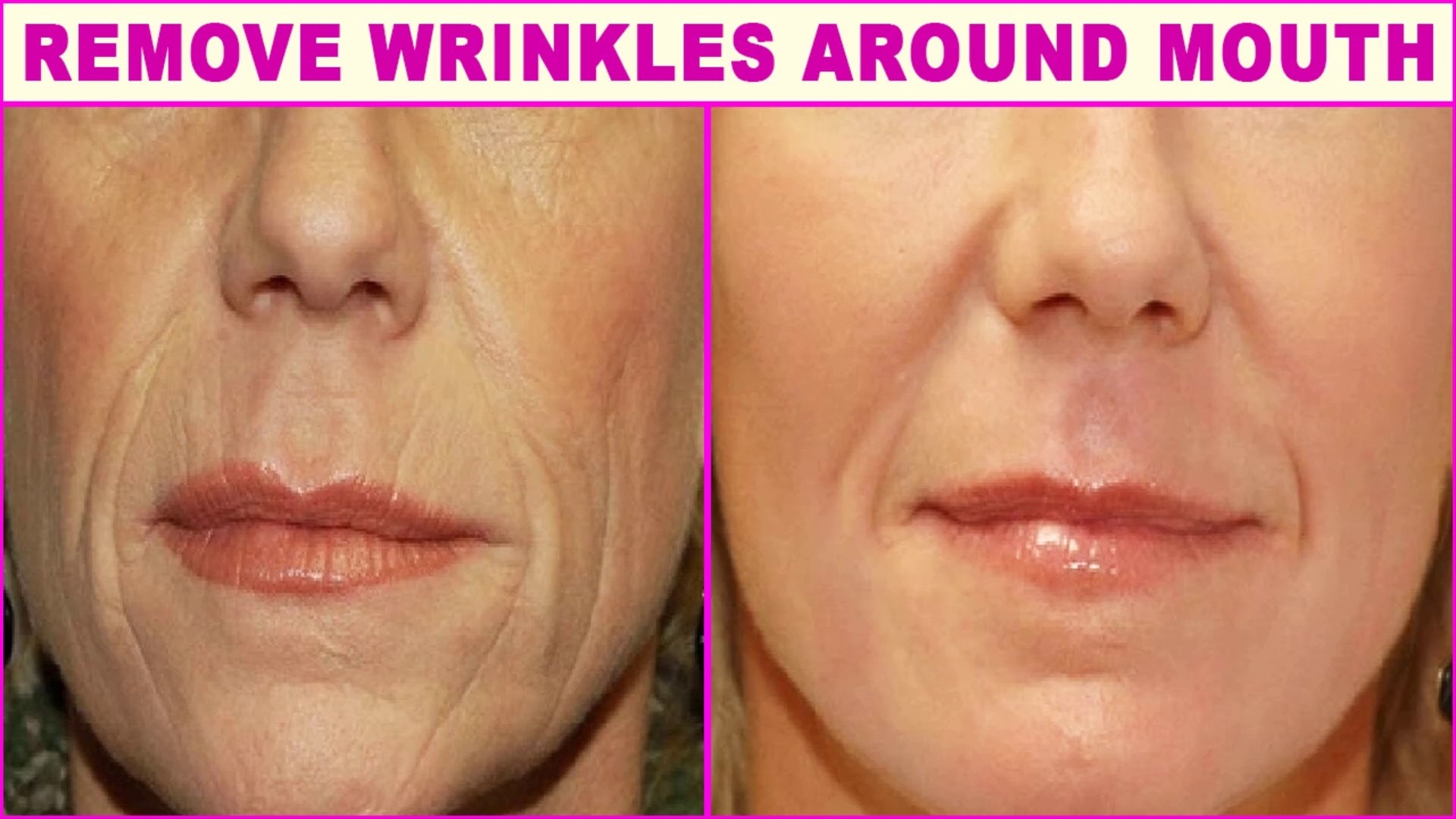 how to get rid of wrinkles around mouth naturally